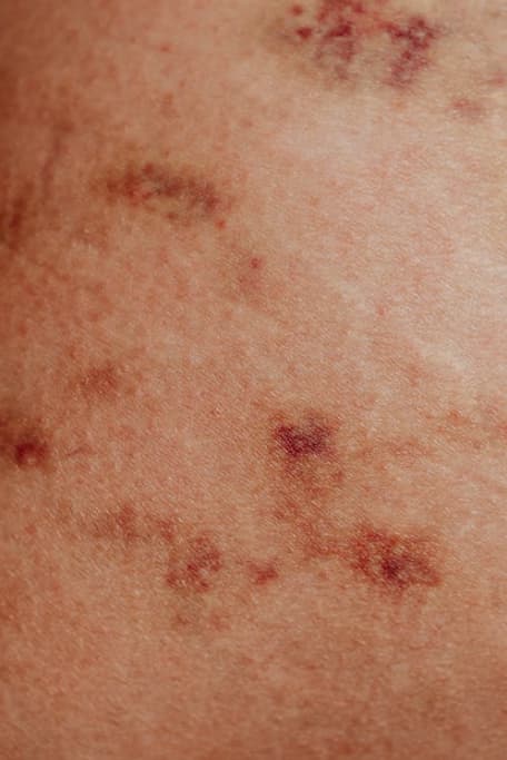 Dermatitis atópica en México